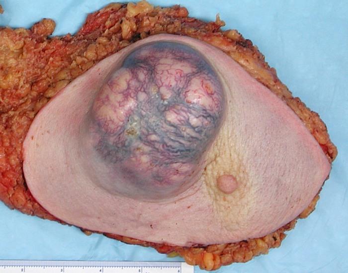 A large invasive ductal carcinoma
