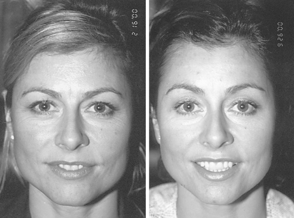 1248 PLASTIC AND RECONSTRUCTIVE SURGERY, April 1, 2004 FIG. 7.(Left) A 39-year-old woman before endoscopic brow lift with suture and drill hole fixation and lower blepharoplasty.