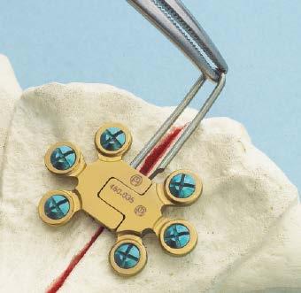 To facilitate plate and screw removal, the DePuy Synthes Universal Screw Removal