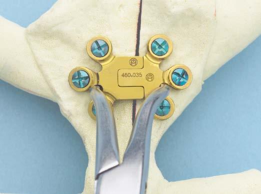 Emergency Reentry Insert emergency release pin To reclose the sternum, a forceps or reduction