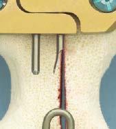 The closed end of the emergency release pin should be oriented cranially with the sloped bend