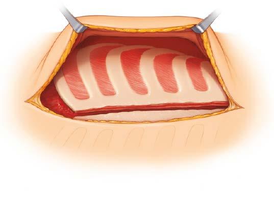 Surgical Technique 3 Expose ribs laterally, if necessary Beginning medially, elevate the pectoralis major muscles with overlying soft tissue attached to create flaps and permit later approximation in