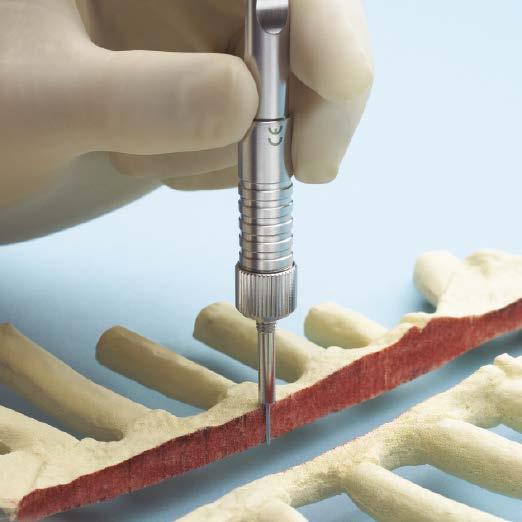 Following debridement and muscle elevation, pulse lavage the entire surgical site with an adequate volume of saline with antibiotics. 4 Measure sternal edges Instrument 319.