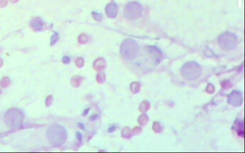 Figure 3. Showing sertoli cells (H&E, X400). Spermatids showed uniform granular nuclear chromatin. The cytoplasm was more abundant in immature forms, gradually diminishing as cells matured (Figure 1).