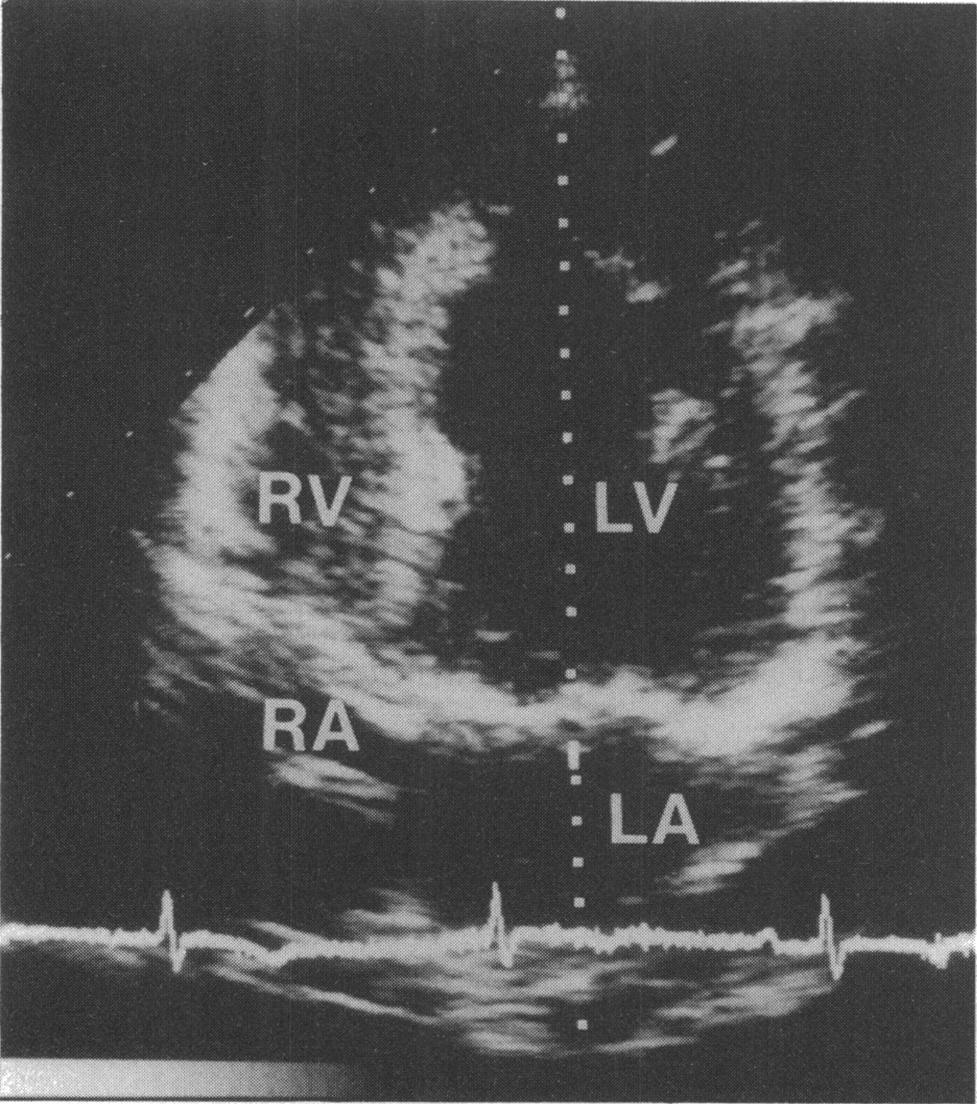 Left ventricular diastolicfilling in cardiac amyloidosis specimens of the stomach, rectum, or sural nerve.