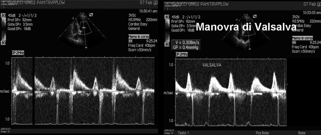 Left ventricular diastolic function by Doppler echocardiography Fig.