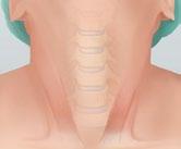 ACDF stands for Anterior Cervical Discectomy and Fusion which is the joining of two bones together.