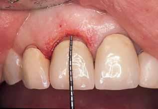gingival margin (GM), clinical attachment level (CAL), and furcation involvement (F) in