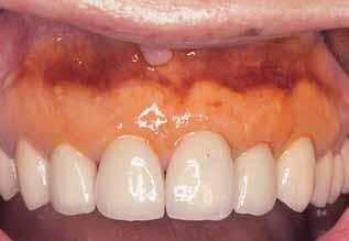 a Fig. 16a Intraoral view showing the clinical situation of the anterior maxilla after periodontal plastic surgery and restorative dentistry. b Fig.