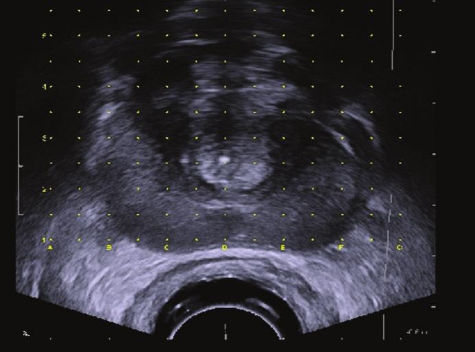 TRANSRECTAL ULTRASOUND-GUIDED PROSTATE BRACHYTHERAPY 3 Prostate brachytherapy is a valid alternative to radical prostatectomy and external beam radiotherapy for localized prostate cancer.