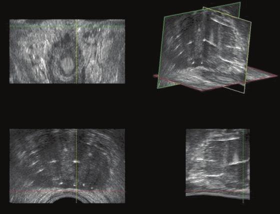 TRANSRECTAL ULTRASOUND-GUIDED PROSTATE BRACHYTHERAPY 4 The bladder may be catheterized, and radiographic contrast can be introduced into the bladder to facilitate fluoroscopy of the bladder base.