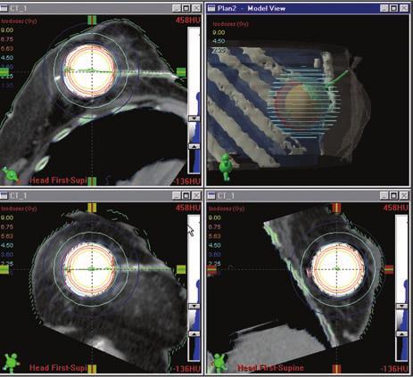 The Acuity BrachyTherapy Suite s cone-beam CT (CBCT) quickly generates highresolution 3D images of tumors and surrounding anatomy, which allow easy identification and localization during treatment