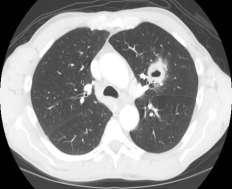 3: Lung Carcinoma with internal necrosis Internal Calcifications and Necrosis: None of the tumors were statistically significantly associated with internal calcifications and internal necrosis.