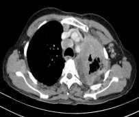 Fig. 5: Lung Carcinoma with mediastinal lymphadenopathy Table 8 : Percentage Distribution Of Tumors By Mediastinal Invasion Pathological type Number of Lesions with mediastinal