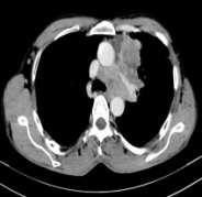 6: Lung Carcinoma with mediastinal invasion Mediastinal Lymphadenopathy And Mediastinal Invasion: None of the tumors were significantly associated with mediastinal lymphadenopathy