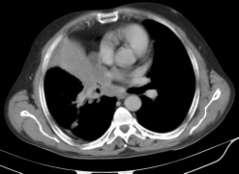 Pleural Effusion: Pleural effusion is common in the adenocarcinoma and small cell carcinoma due to their early metastatic characteristic.