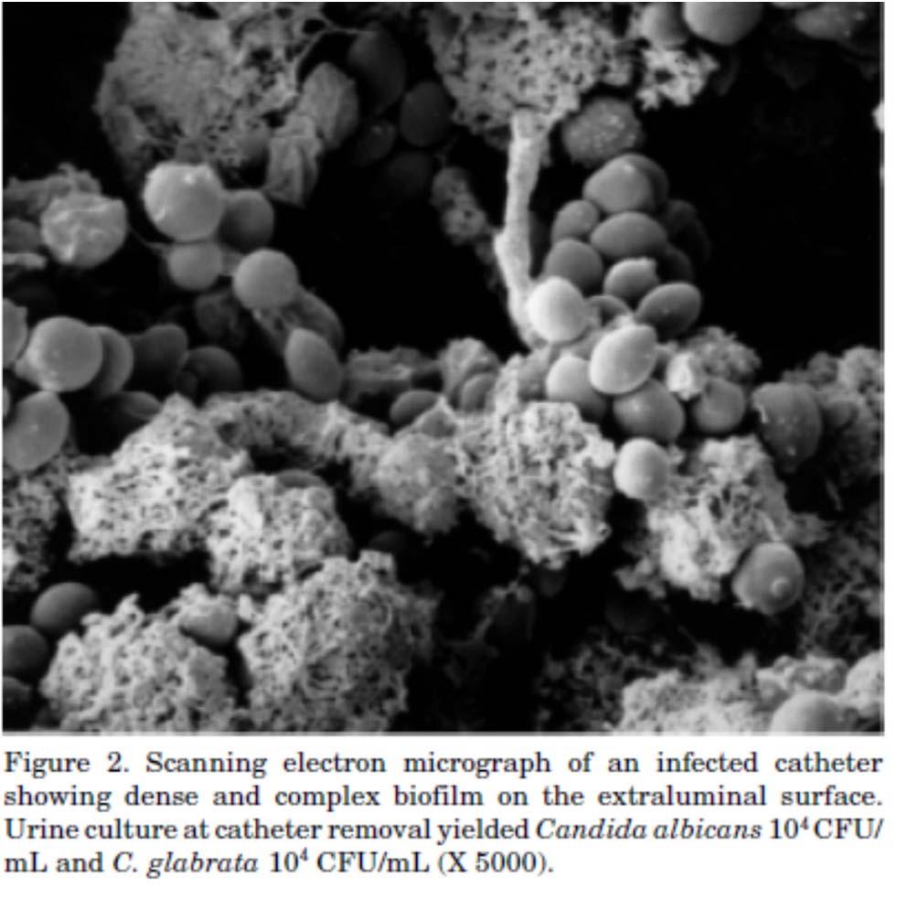 PATHOGENESIS OF CA UTI Formation of biofilms by urinary pathogens common on surfaces of catheters and collecting systems
