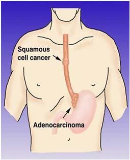 Esophageal Cancer Two most common subtypes» Squamous cell cancer» Adenocarcinoma Squamous cell cancer» Originates from the cells that line the esophagus» It occurs in the upper & middle portion» It