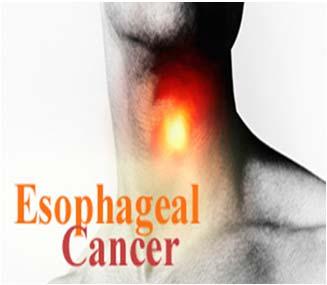 org/ Epidemiological Shift Epidemiology of esophageal cancer has changed over several decades Squamous cell carcinoma was responsible for 90% of the cases of esophageal carcinoma in the United States
