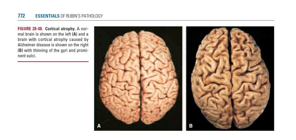 The Brain in Alzheimer s Disease