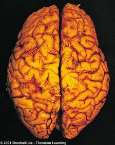 Diencephalon Hypothalamus