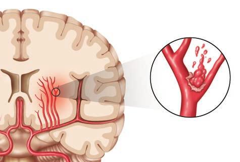 Stroke, TIA and Warning Signs Hemorrhagic Stroke Stroke occurs when a blood vessel bringing blood and oxygen to the brain gets blocked or ruptures.