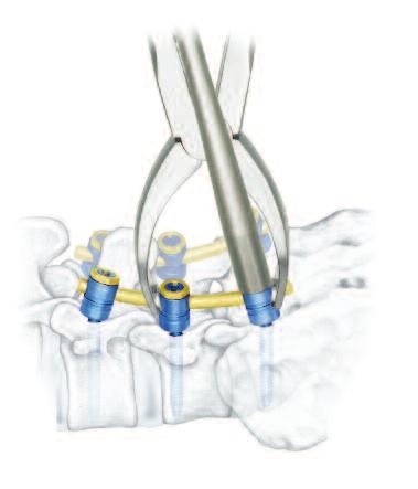 rods designed to mimic spinal curvature Permits sagittal and lateral screw
