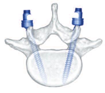 posterior compression Provides stable internal fixation Dual core screw