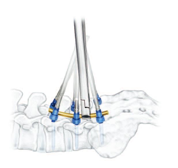 The polyaxial mobility of the screw head aids in compensation for a lateral screw offset.