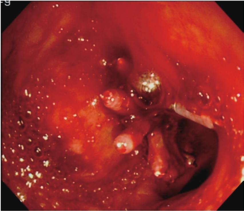 vessel trunk visible in the anterior duodenal