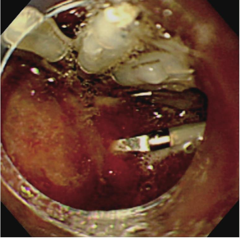 Duodenoscopy showed no bleeding, but there was a shallow ulcer proximal to the bleeding ulcer site (Fig. 7).