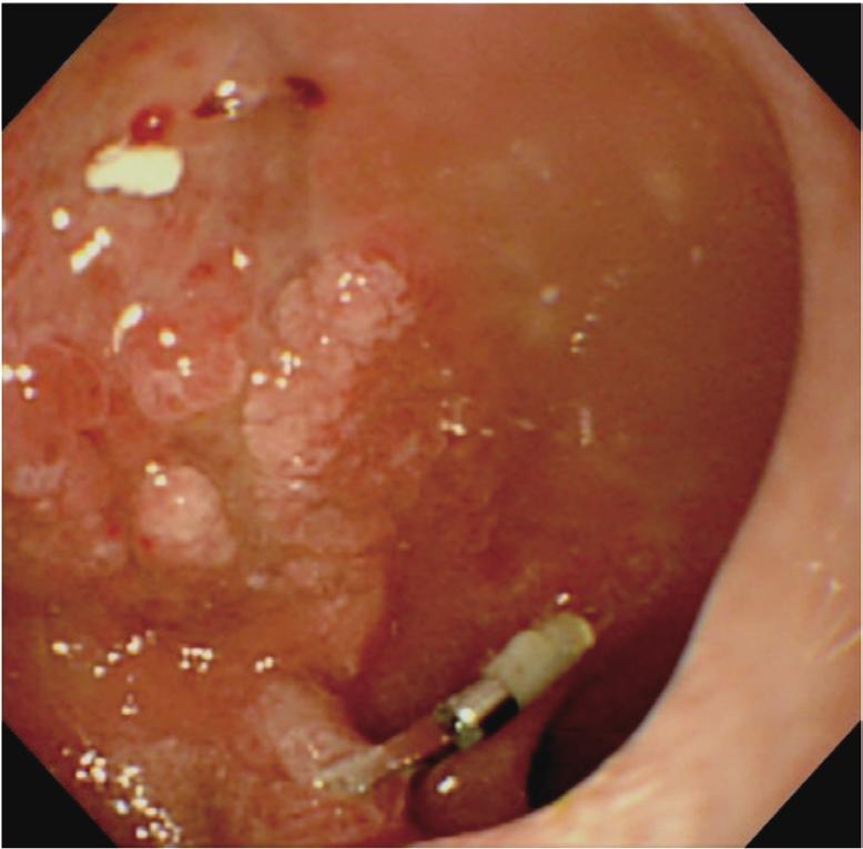 in the anterior duodenal bulb, but
