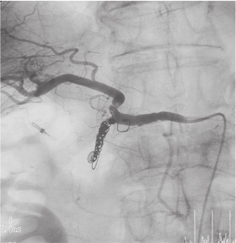 13 A coil was added in the right gastric artery to stop blood flow from the pyloric branches. Fig.