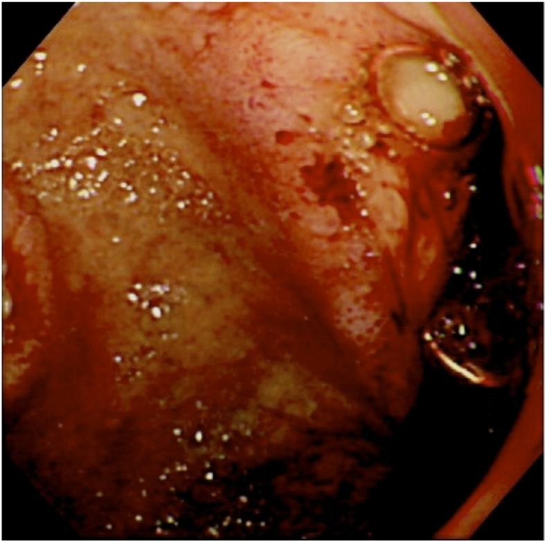 15 Exposed coil visible from the vessel trunk of the ulcer base. There is no bleeding, but distal to the prior bleeding ulcer, a post-tae ulcer is noted.