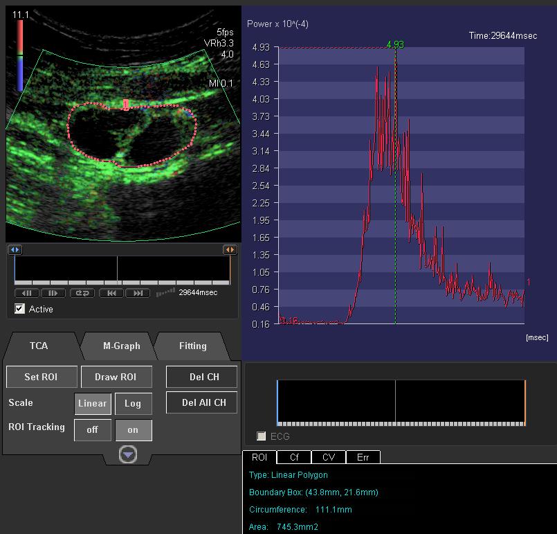 Dynamic contrast enhanced ultrasound Baseline GIST, Pelvic met Rx Dasatanib After D 7 After 1 month Contrast Media (Agents) Used in CT, MRI, and ultrasound Enhance the difference in image intensity