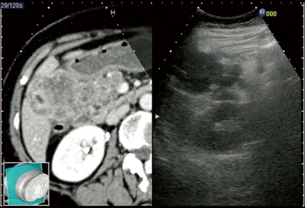 duct cancer (excellent case); the positional relationships among the tumor and vessels (SMA, SMV and PV) were well evaluated; D: Bile duct cancer (excellent case); the positional relationship between