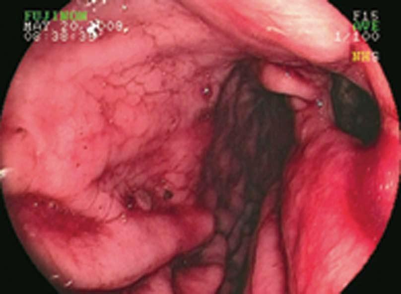 Sayana H et al. Hepato-gastric fistula presenting as GI bleeding with HCC [3]. Lung is the most common site of metastasis followed by intra-abdominal lymph nodes, and bone and adrenal glands [3].