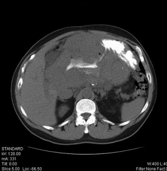 Sayana H et al. Hepato-gastric fistula presenting as GI bleeding A A B C R L 200 mm 200 mm 100 mm P Figure 2 Computerized tomography images of the abdomen.