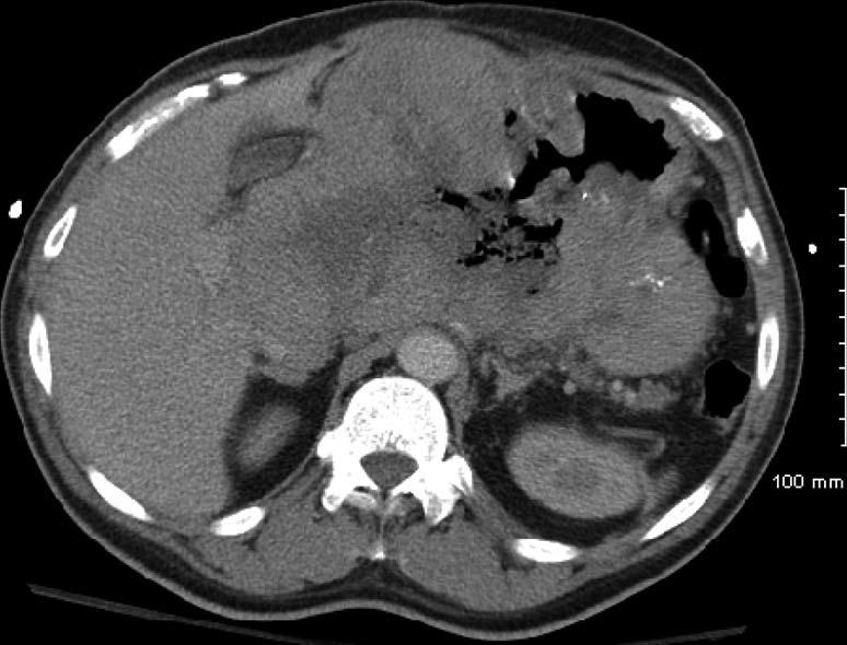 In our patient, we suspect an exophytic tumor growth pattern causing direct GI tract invasion and pressure necrosis on adjacent organs.