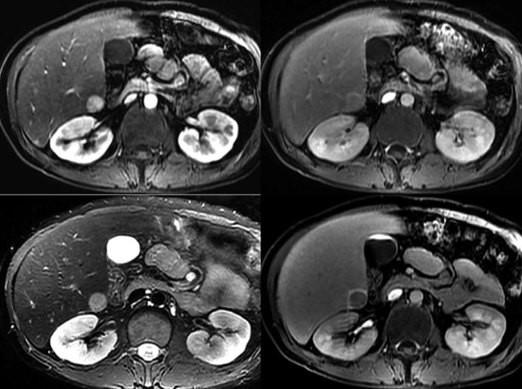 The mass shows nearly iso-signal intensity with capsular enhancement on 3 min delayed phase (right upper), intermediate high signal intensity on axial T2-weighted image (left lower), and clear defect
