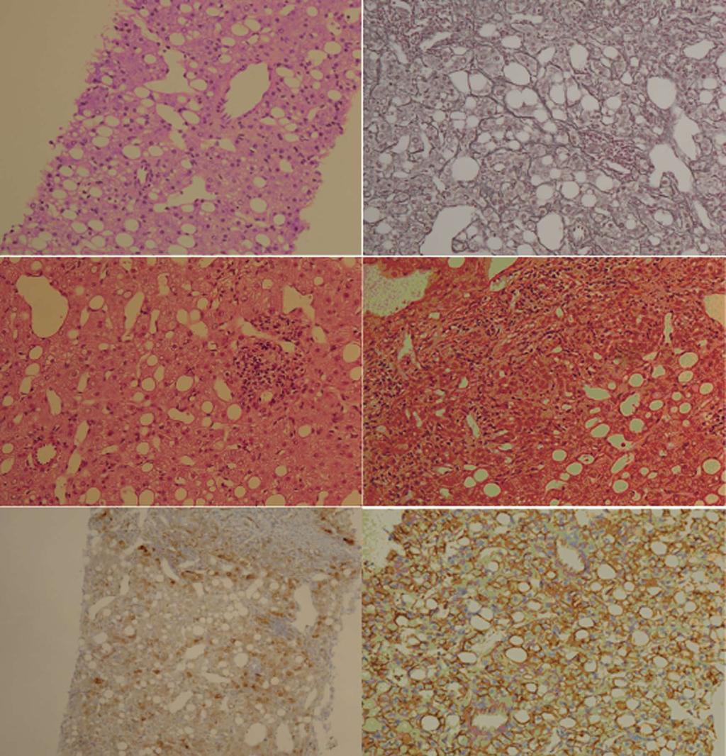 Ahn SY et al. Treatment according to hepatocellular adenoma subtype A B C D E F Figure 2 The histological features are consistent with the inflammatory type of hepatocellular adenoma.