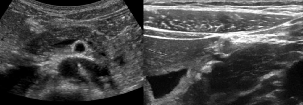 Dimcevski G et al. Modern ultrasonography in chronic pancreatitis A MR B RLL Cor MR Cap Msa Cau RLL Cor Ao Duo Cap Figure 1 Pancreas and the surrounding anatomical landmarks.