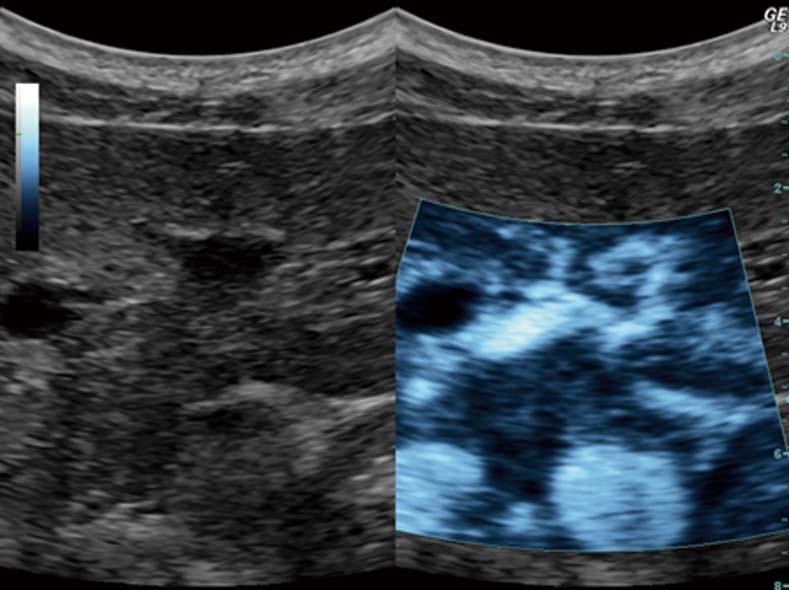 Dimcevski G et al. Modern ultrasonography in chronic pancreatitis Figure 4 Ultrasound targeted treatment of pancreatic cancer using combined microbubbles and a chemotherapeutic. Left: B-mode frame.
