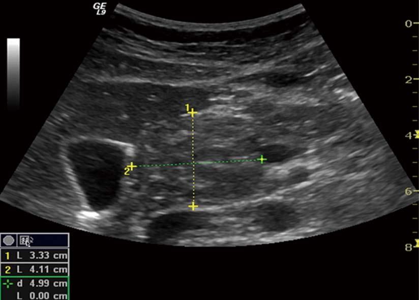 This subtle changes are usually only seen in endoscopic ultrasonography. morphological changes, where imaging modality falls short in diagnosing CP.