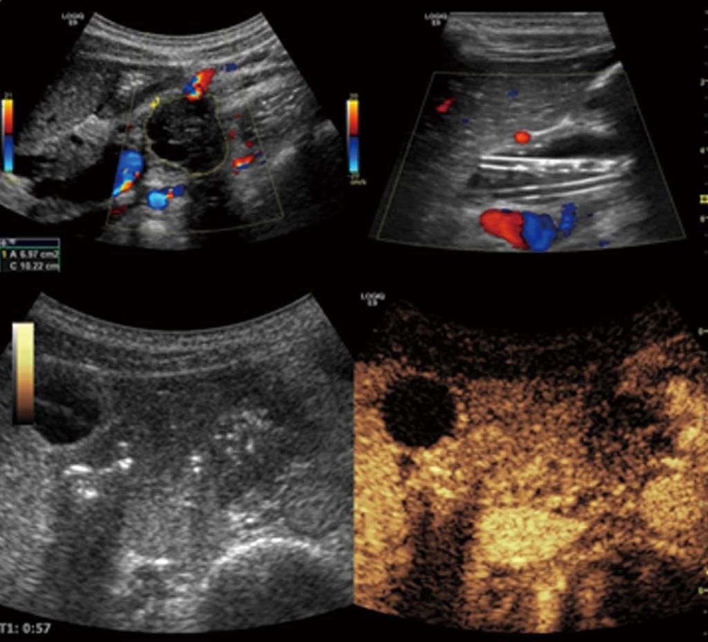 Dimcevski G et al. Modern ultrasonography in chronic pancreatitis CEUS Cho Tu Figure 12 Malignant tumor of the pancreatic body: Ductal adenocarcinoma.