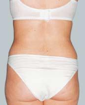 She required a two stage procedure, with removal of three litres of fat