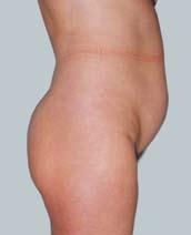 For the second procedure, removal of fat from the outer thighs and upper