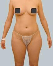 Liposuction was performed to the abdomen, upper hips and outer