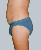 Liposuction was performed to the front and outer thighs to