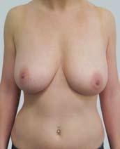case study 12 to the breast This 24 year old female